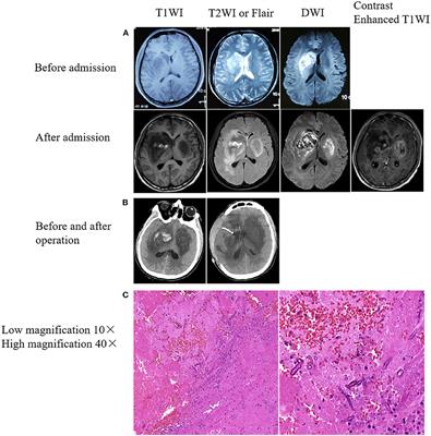 Fatal and Rapid Progressive Isolated Cerebral Mucormycosis Involving the Bilateral Basal Ganglia: A Case Report
